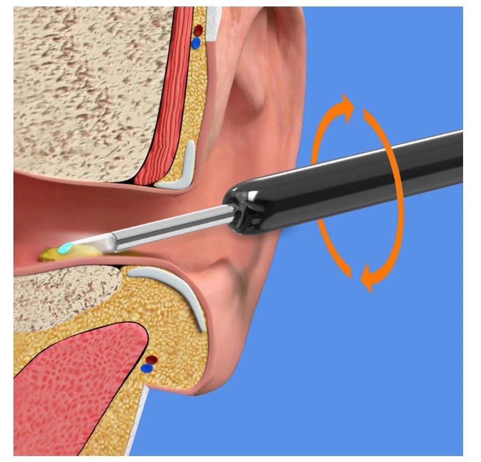 Wireless Earwax Removal Kit with HD Otoscope - Aleenext